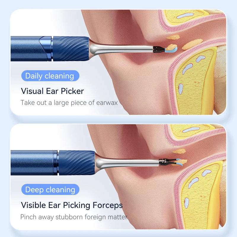 Ear Wax Removal 2-in-1 Visual Otoscope Ear Cleaner Tweezers with 6 Ear Spoon Earwax Removal Kit with Light  Ear Cleaner